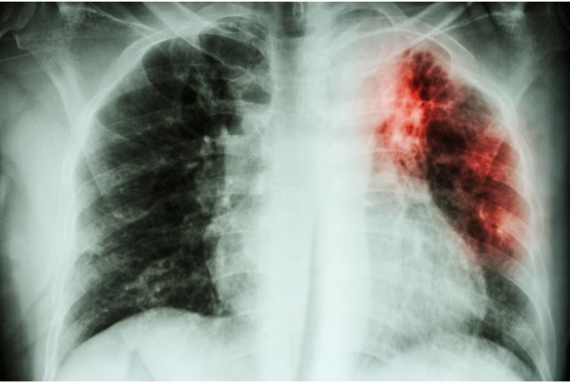  Cerner la tuberculose : causes, traitements et défis actuels pour la santé publique