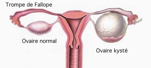  Comprendre les kystes ovariens : causes, symptômes et options de traitement