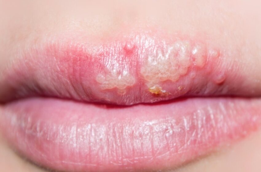  Comprendre l’herpès buccal : symptômes, causes et traitements