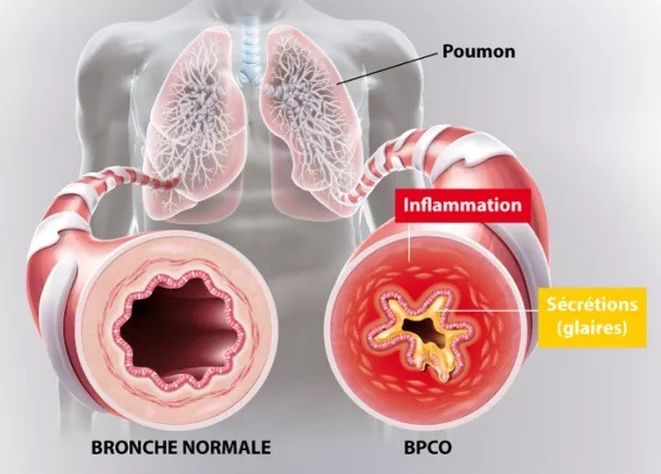  Respirer facilement : gestion des maladies respiratoires et prévention des exacerbations”