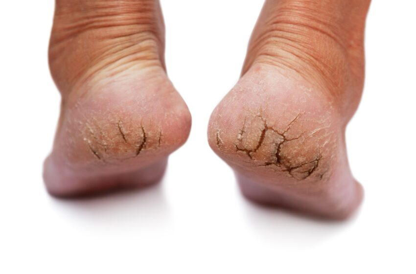  Callosités des pieds : comprendre, traiter et prévenir