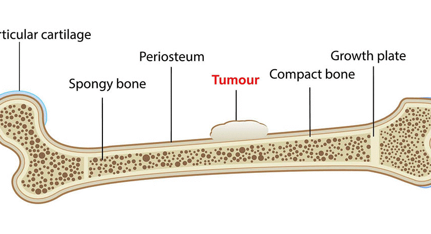  Le cancer des os :une maladie rare mais grave
