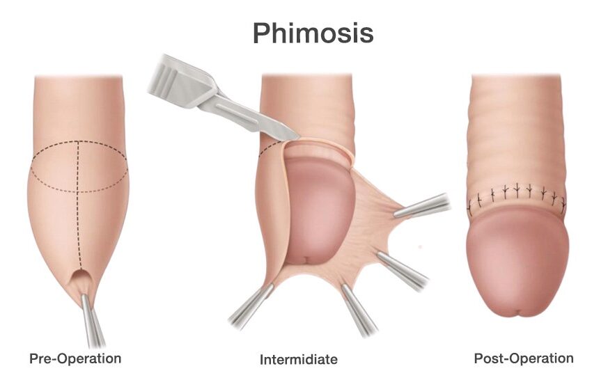  Phimosis : causes et traitements