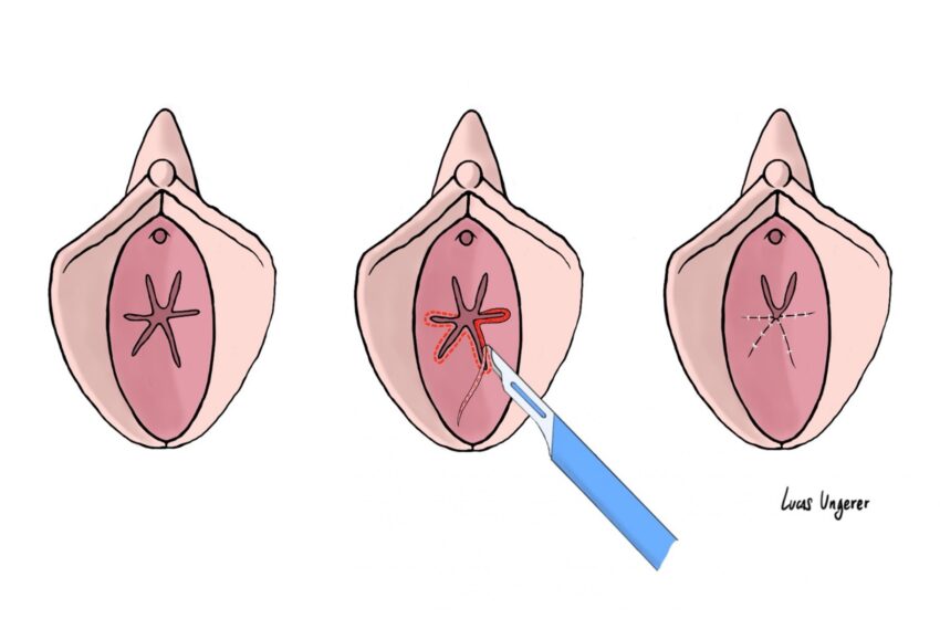  Hyménoplastie : reconstruction de l’hymen