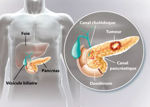  Le cancer du pancréas : un tueur silencieux à surveiller de près