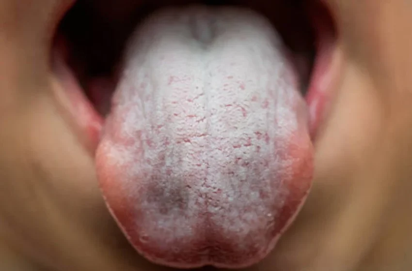  La candidose buccale : causes, symptômes et traitements