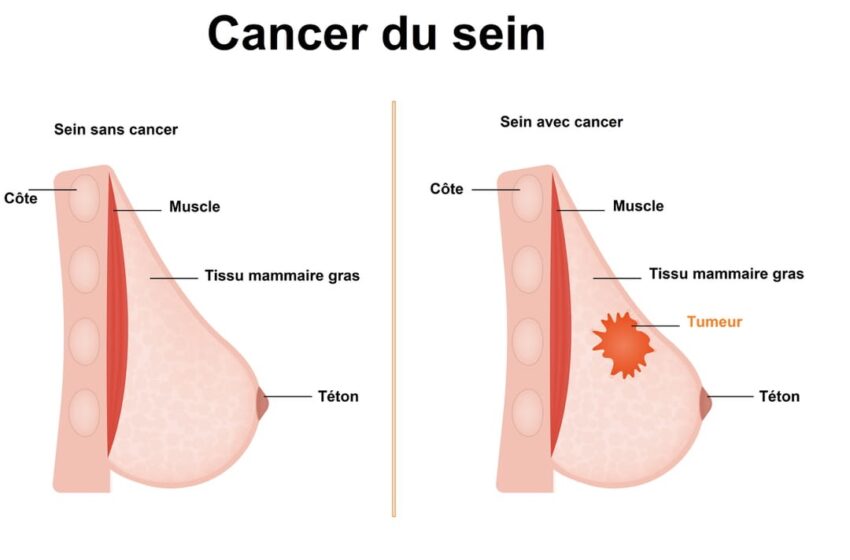  Cancer du Sein : symptômes, dépistage et prise en charge
