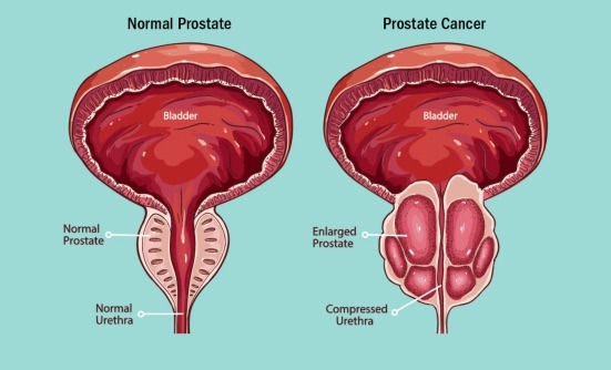  Le cancer de la prostate : comprendre, prévenir, et mieux vivre avec