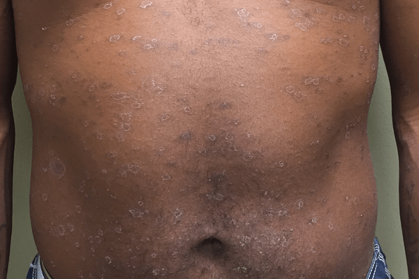  Le Pityriasis : une affection cutanée courante et souvent bénigne