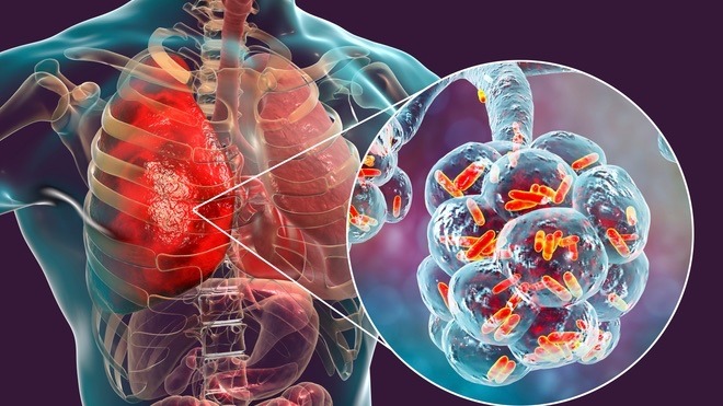  La pneumonie : une infection respiratoire à ne pas négliger