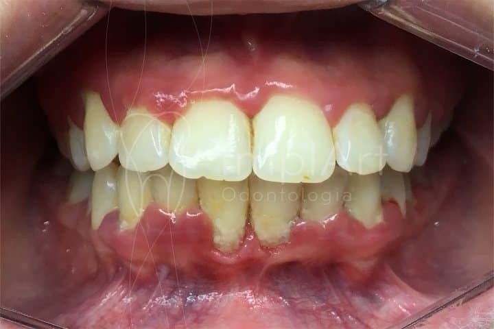  Comprendre et traiter la gingivite : un guide complet