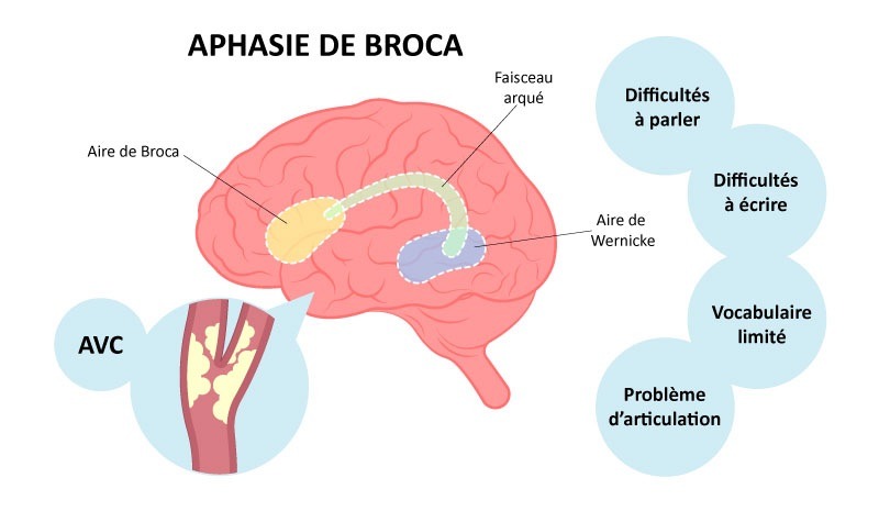  L’aphasie de Broca : comprendre et gérer cette atteinte du langage