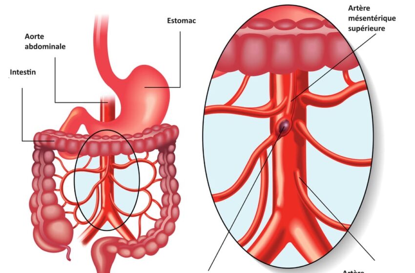  Infarctus digestif : une urgence silencieuse à ne pas négliger