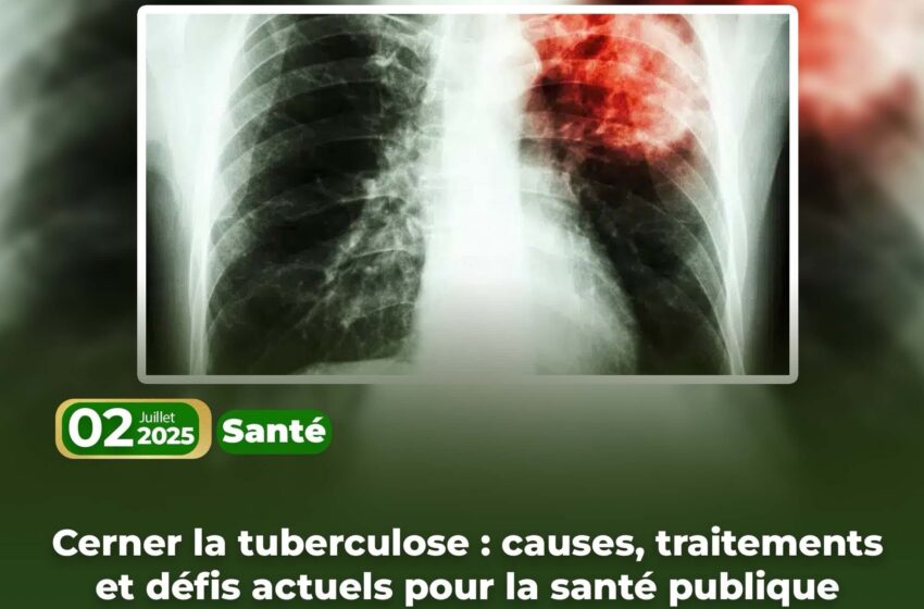  Cerner la tuberculose : causes, traitements et défis actuels pour la santé publique