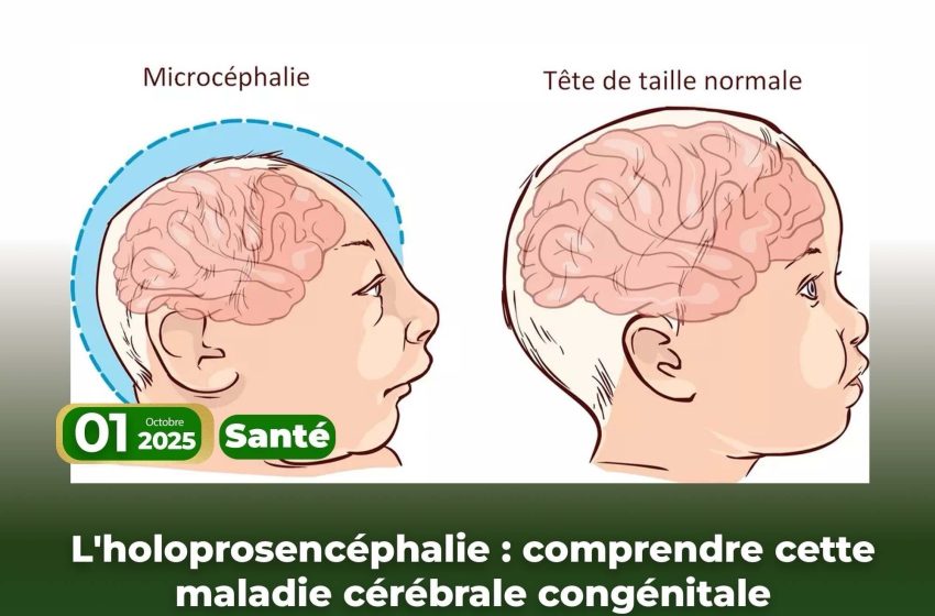  L’holoprosencéphalie : comprendre cette maladie cérébrale congénitale