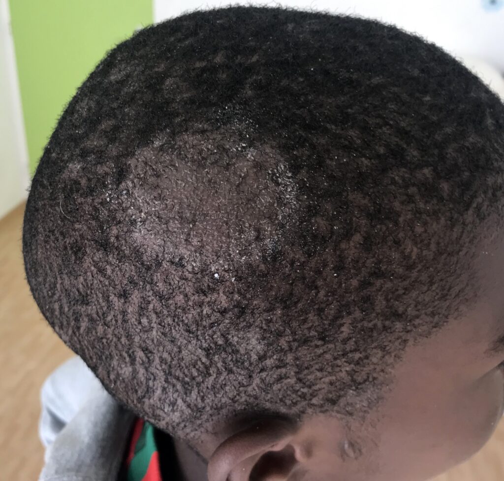 La teigne, une infection cutanée commune mais méconnue