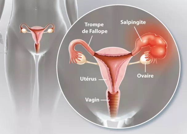  La salpingite : symptômes, diagnostic, traitement et prévention