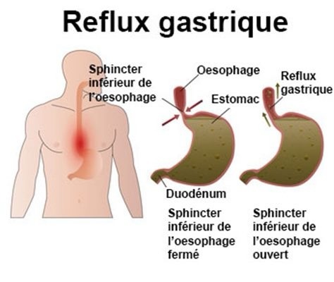  Soulager les reflux gastriques naturellement: 8 remèdes à explorer