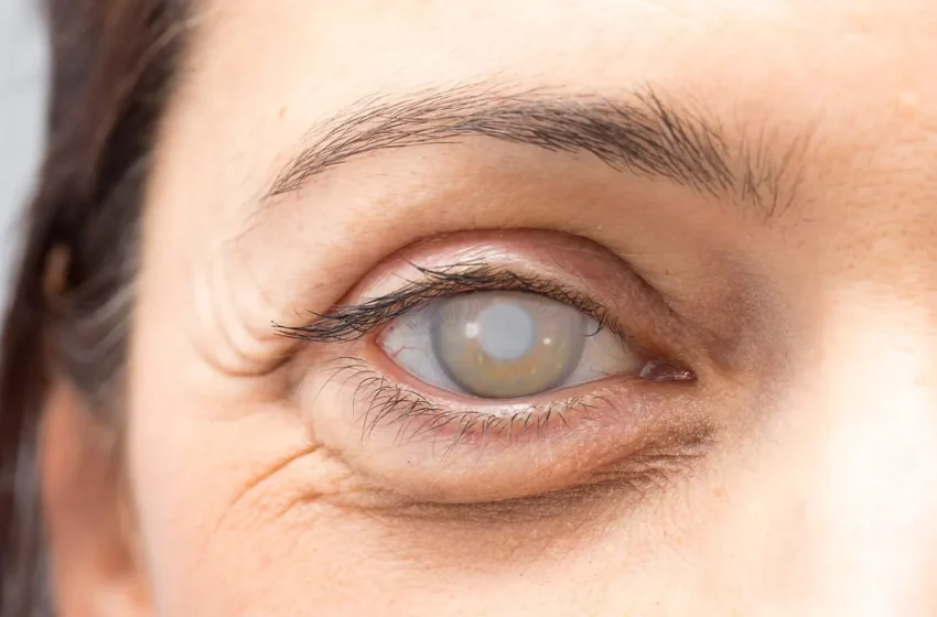  Comprendre la cataracte : symptômes, causes et options de traitement