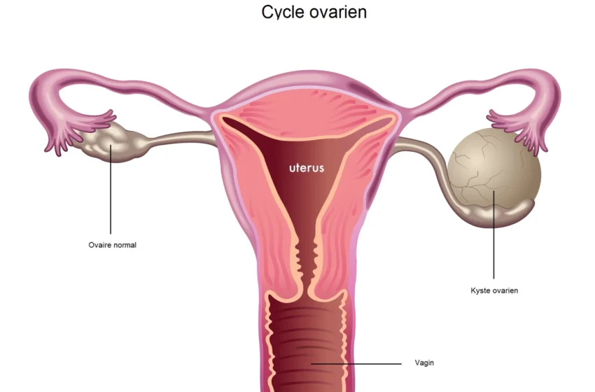  Comprendre les kystes ovariens : symptômes, causes et traitements