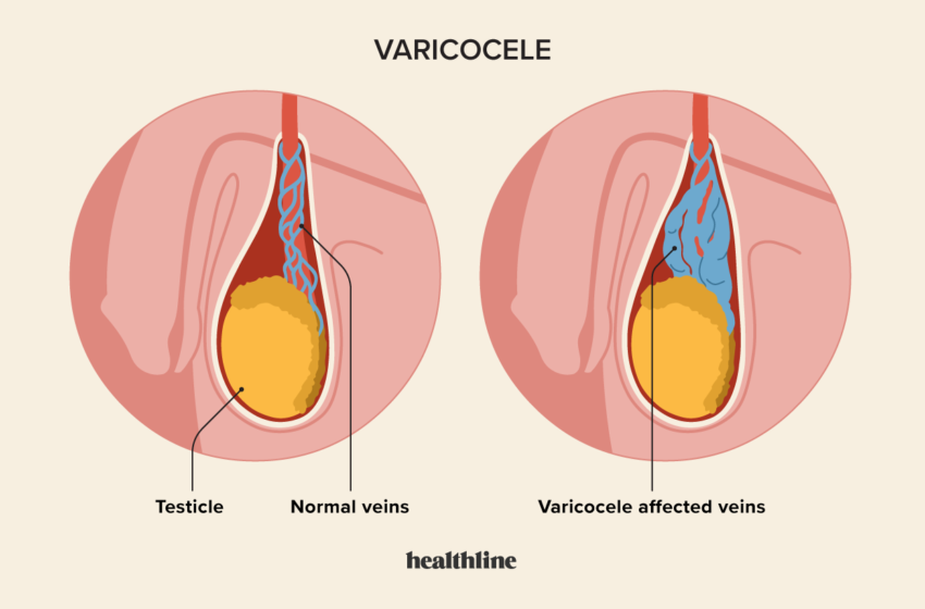  Varicocèle : comprendre cette affection courante et ses impacts sur la santé masculine