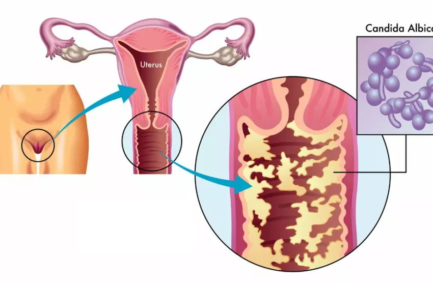  Candidose vaginale : comprendre, prévenir et traiter cette infection courante