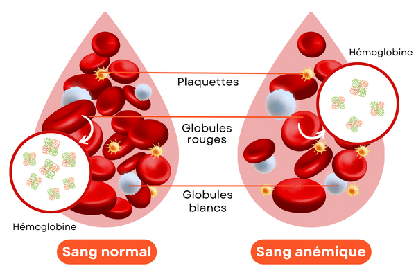  L’anémie : comprendre et prévenir cette maladie silencieuse
