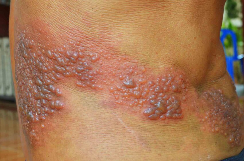  Comprendre le zona : symptômes, causes et traitements