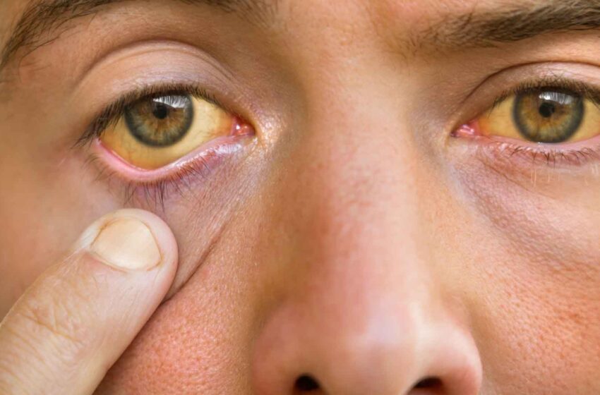  L’Ictère : comprendre cette affection courante du foie