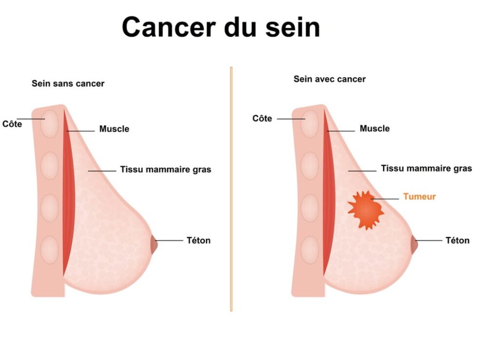 Cancer du Sein : symptômes, dépistage et prise en charge