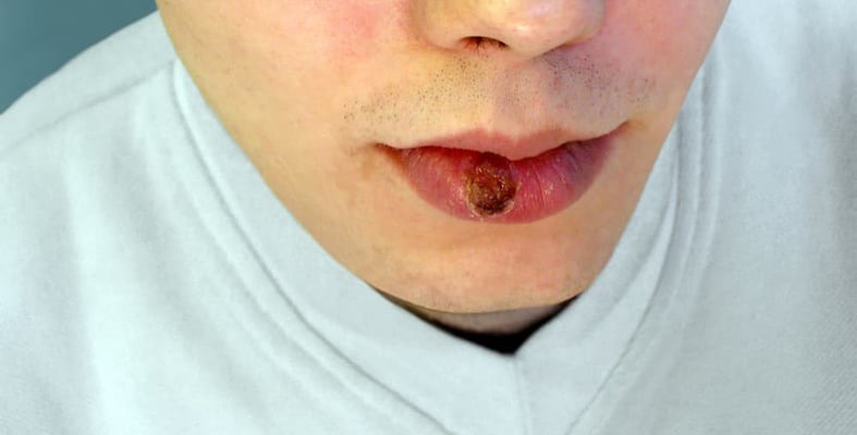  Chancre mou: causes et traitements