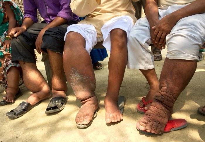  L’éléphantiasis : quand un simple moustique bouleverse une vie