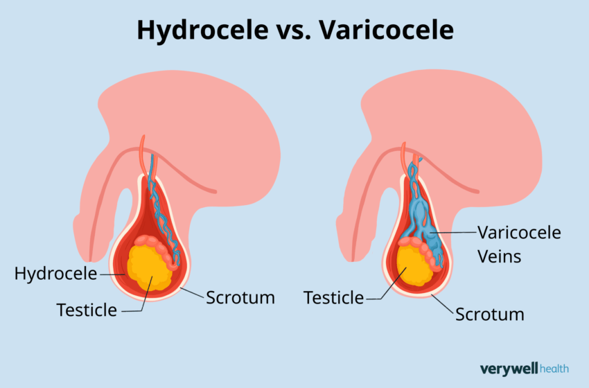  Hydrocèle : comprendre et traiter cette affection testiculaire