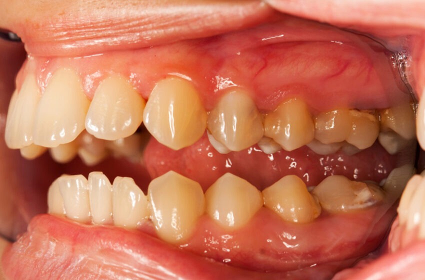  Éliminez le tartre naturellement et retrouvez un sourire éclatant