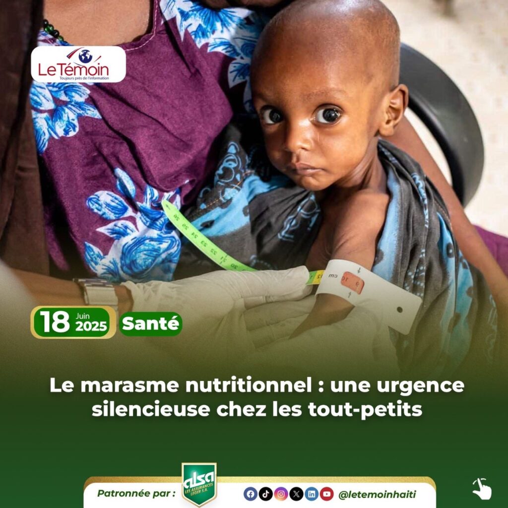 Le marasme nutritionnel : une urgence silencieuse chez les tout-petits