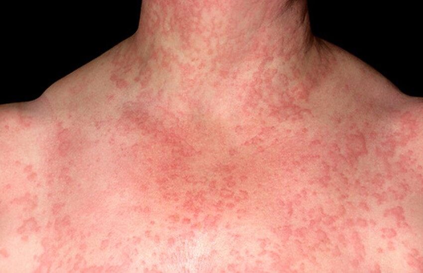 Èske w te konnen gen moun ki ka fè alèji ak dlo, menm dlo pwòp?