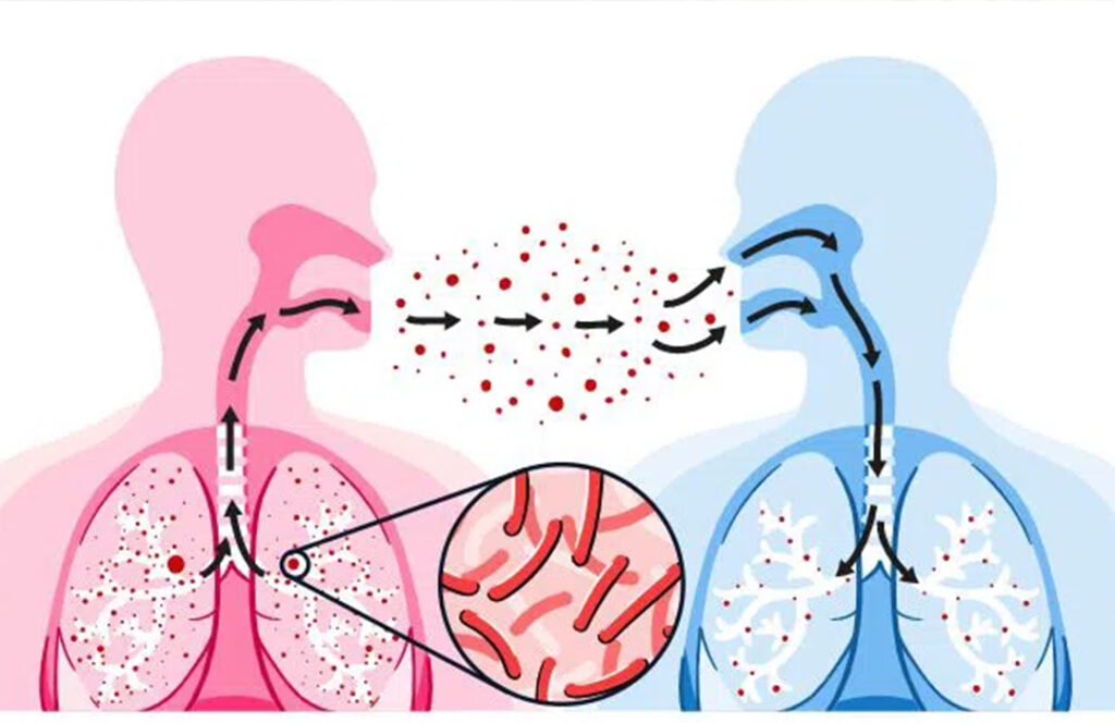 Tuberculose en Haïti : une maladie toujours présente, mais évitable et guérissable