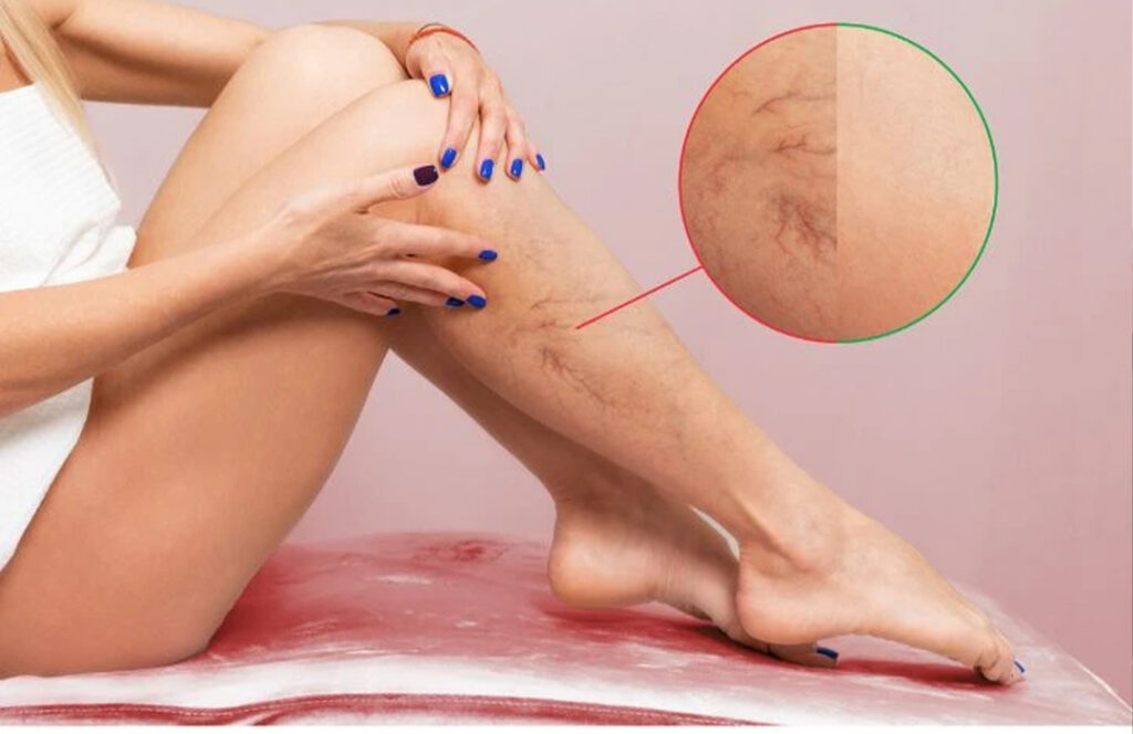 TVP : le danger silencieux qui circule dans nos veines