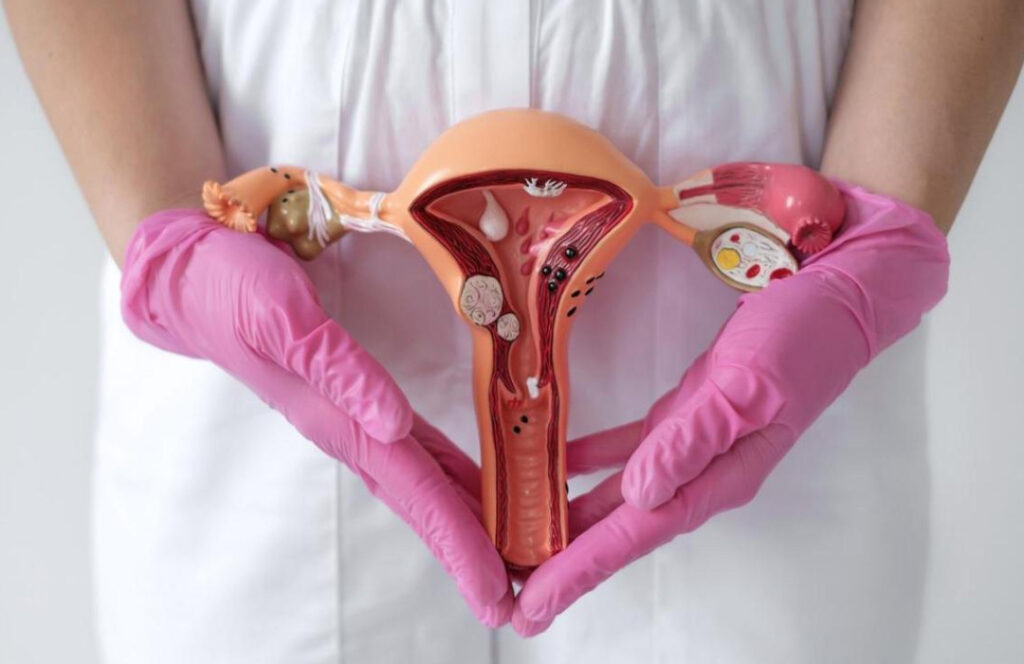 Les fibromes utérins : un problème de santé fréquent chez les femmes