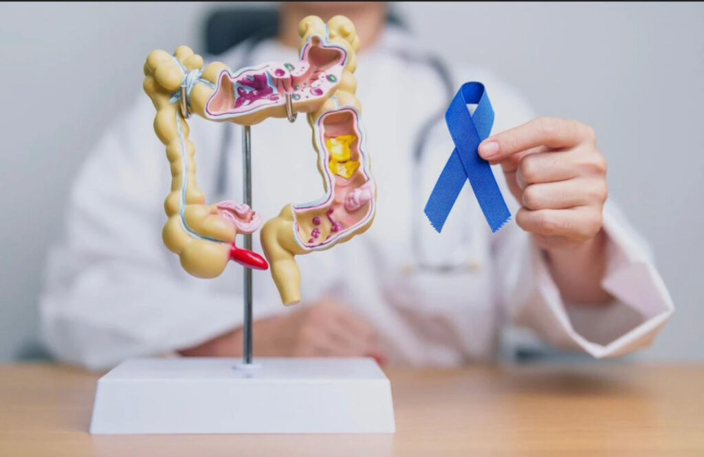 Le cancer du côlon : un danger silencieux à ne pas ignorer
